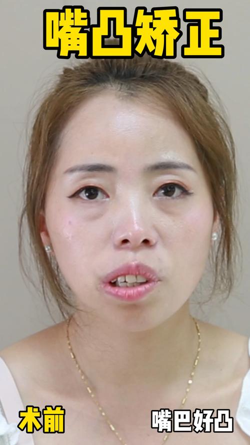拍照时感觉自己嘴歪_镜头脸歪？可能是咀嚼单边或健康问题