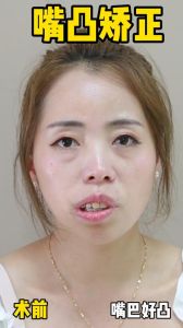 拍照时感觉自己嘴歪_镜头脸歪？可能是咀嚼单边或健康问题