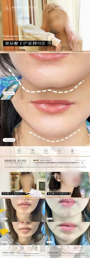 怎么修图下巴变宽_下巴宽度调整,美图秀秀甜盐相机助你自然变美 怎么修图下巴变宽_下巴宽度调整,美图秀秀甜盐相机助你自然变美