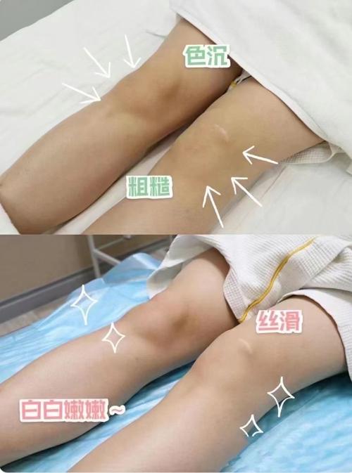 全身美白对比高清图_角质厚难美白?先去角质,选对精华! 全身美白对比高清图_角质厚难美白?先去角质,选对精华!