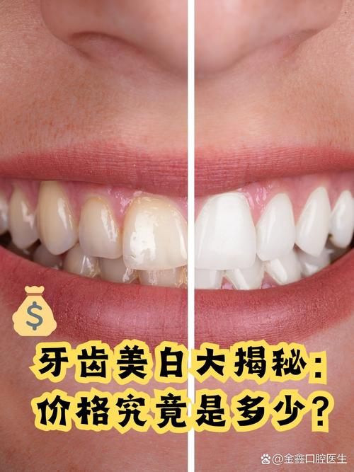 牙齿美白对比高清图_牙齿美白，告别黄牙显气质！