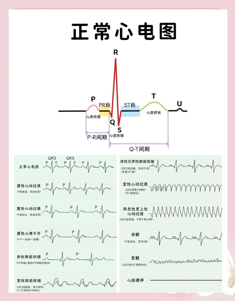 心电图怎么看参数图_心电图看心脏，波形变化知健康